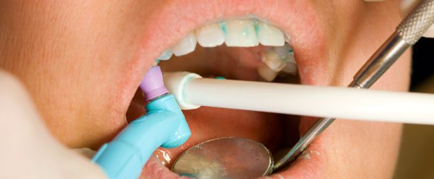 dental cleaning in los angeles