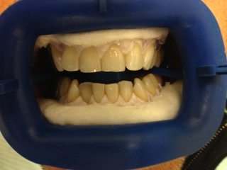 zoom whitening los angeles
