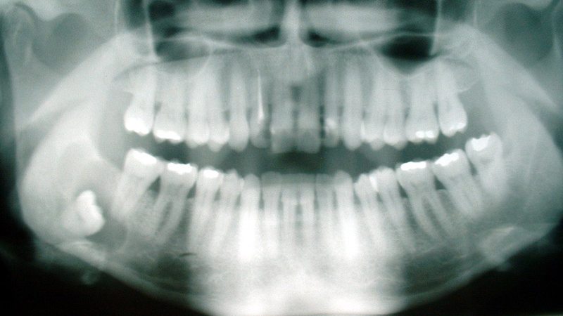 cyst wisdom teeth pain dentist downtown la