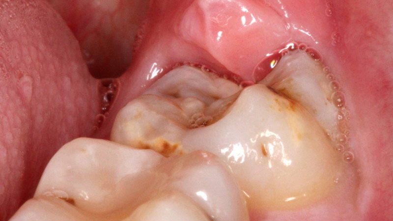 wisdom teeth pain remedies