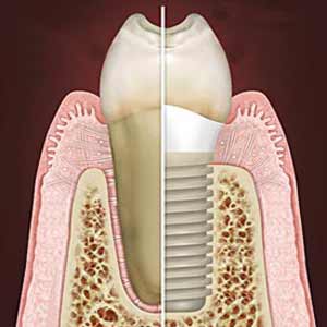 Dental Implants in Los Angeles