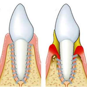 Gum Disease: Periodontitis Treatment in Los Angeles
