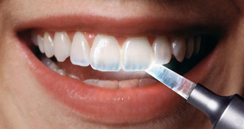 tooth enamel erosion treatment in los angeles