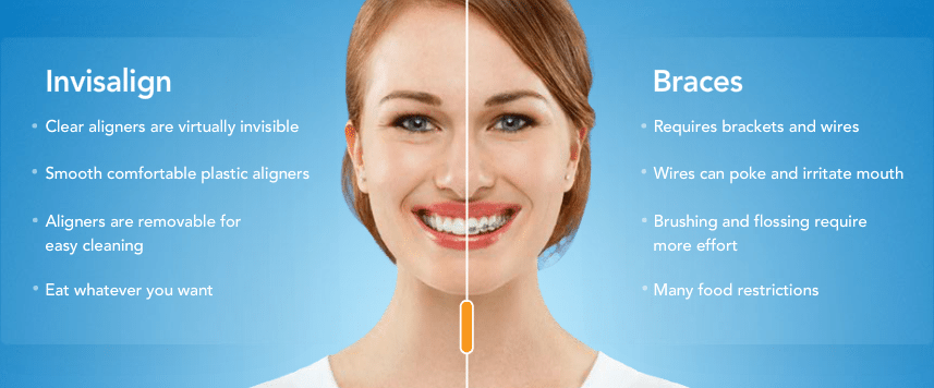 dentist invisalign in los angeles