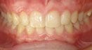 overbite-after