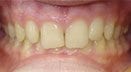 overbite-before