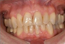 teeth-whitening-before-sm