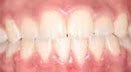 underbite-after