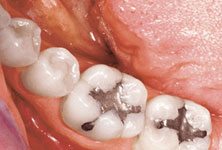 white-fillings-before-sm
