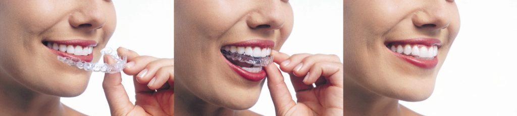 Putting on Invisalign Braces